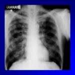 Guide d’aide à la déclaration des pathologies professionnelles respiratoires 2003 (version flash)