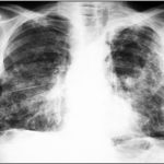Pathologies professionnelles pulmonaires